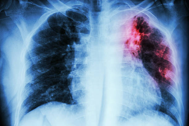 Существенное снижение числа случаев туберкулеза в Индии: MoS Health
